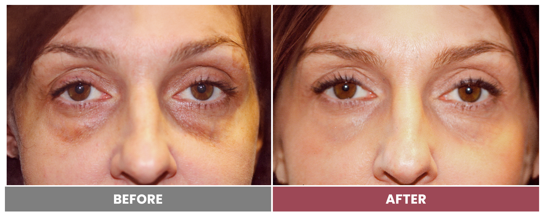 LASER SKIN RESURFACING - Case 9